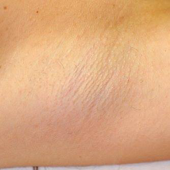 Customer underarms after