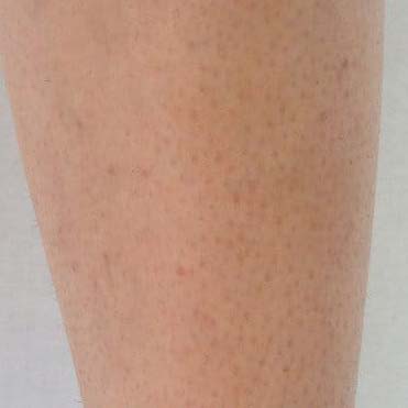 Janie's legs after 4 weeks