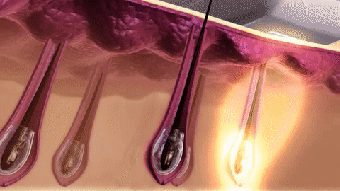 SnowySkin IPL laser hair removal technology demonstration